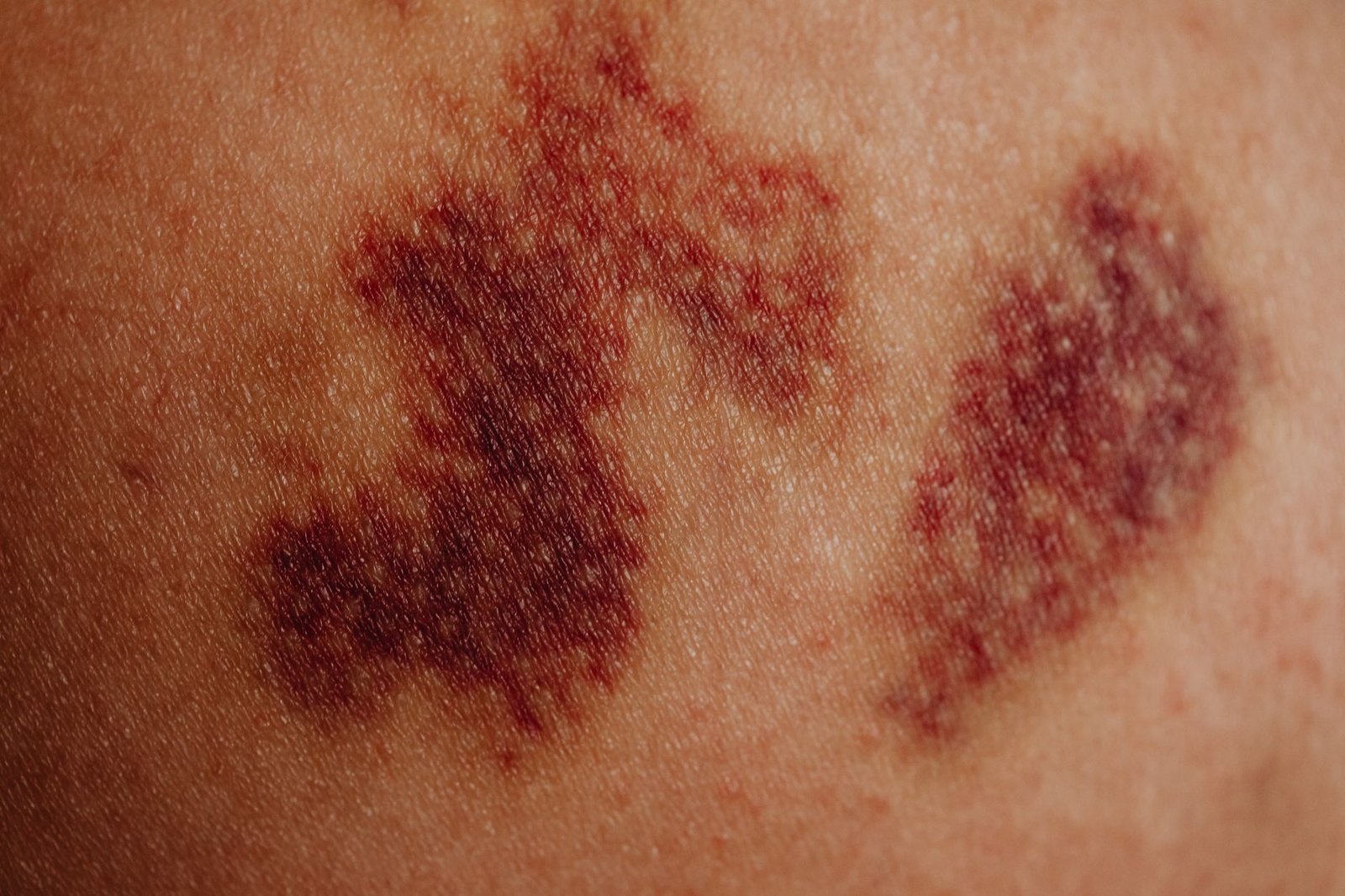 Arnica Homeopathic Gel Bruise Muscle Soreness Dance